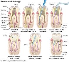 What is root canal therapy?